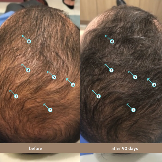 Serum con Nanoxidil 5% para el cabello